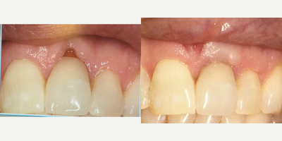 45-54 year old woman treated with Gingival Graft - Connective tissue graft after recession.