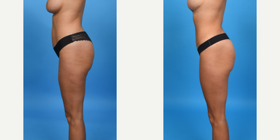 35-44 year old woman treated with Abdominal Etching, Diastasis Recti Repair, Liposculpture, Liposuction, Liposuction Revision, M - This patient was not happy with her tummy tuck done by another surgeon.  I did a revision tummy tuck.  I lowered her scar using a bikini incision, did vaser ultrasound liposuction of her abdomen and waist, removed excess skin and re-plicated her abdominal muscles.