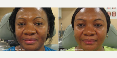 Treated with Cosmelan - Treated with Cosmelan
