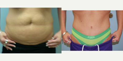 25-34 year old woman treated with Tummy Tuck - Full abdominoplasty with liposuction to flanks
Pre op: 145 lbs/ pant size:8
Post op: 130 lbs / pant size: 2-4