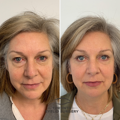 45-54 year old woman treated with Eyelid Surgery - Upper and lower lid blepharoplasty