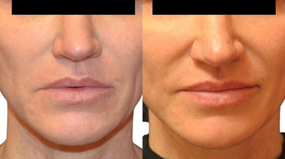 Venus Viva - Before and After 7 Treatments. &nbsp;Photos provided courtesy of Venus Concept, performed by Alexander Cadoux, MD.