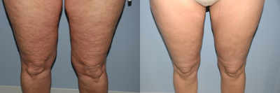 Cellulite Treatment - 
	Age: 52, Ht: 5'6, Wt: 135 Procedure: Cellulaze of the anterior and posterior thighs X's 40 sectors. 20 Months between before and after photos