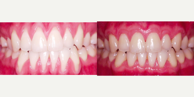 26 year old young man with gum recession - This young man had severe recession and temperature sensitivity in the upper and lower front teeth. Gum grafts arrested any further recession and he is now comfortable and no longer sensitive to hot and cold temperatures.