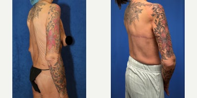 Horizontal Back Lift After Massive Weight Loss | Torsoplasty Transformation - At 65 years old, our patient is a White female who had lost over 100lbs and was left with significant, sagging back skin that would not tighten with exercise. At 115 lbs, her concern was no longer weight loss; it was the uncomfortable back roll and loose tissue that can bunch in bras, and make the upper torso appear heavier than it truly is. Dr. Timothy Katzen recommended a torsoplasty, also called a back lift, using a horizontal incision to remove the hanging skin and restore a smoother, more balanced contour down through the mid-back. Under general anesthesia, Dr. Katzen carefully marked the excess tissue. At the same time, the patient was positioned to show where the skin naturally folds, then a planned horizontal incision was created so the scar could be placed in a discreet location whenever possible. The loose skin and underlying fatty tissue were then removed in a controlled, even manner, with a focus on maintaining a smooth back and avoiding a pulled appearance. In total, Dr. Katzen removed 1.5 lb of excess skin and then tightened and redraped the remaining tissue to improve contour and reduce bulging along the sides of the torso. The incision was closed in multiple layers to promote strong healing, and compression is typically used to reduce swelling and maintain the new contour. These photos were taken 2.5 months after surgery, and her results are already remarkable, showing a flatter back profile and a more defined, youthful torso silhouette, with continued healing refining these features.