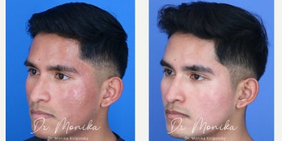 18-24 year old man treated with ResurFX - Age: 18-24 Gender: Male Ethnicity: Hispanic Procedure: ResurFX