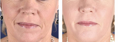 Nasolabial Folds - 4 syringes Radiesse split between nasolabial folds, chin and cheeks