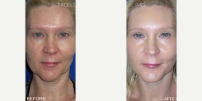 Woman treated with Facelift, CO2 Laser, Eyelid Surgery - Woman treated with Facelift, CO2 Laser, Eyelid Surgery