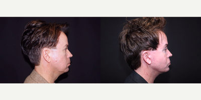 45-54 year old man treated with Facelift, Browlift, Fat Transfer, Genioplasty and Cheek Implants - 53 year old male received a facelift, browlift, fat transfer, genioplasty (chin augmentation) and cheek implants; photos depict the patient's results 3 months post-op.