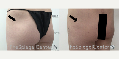 25-34 year old transgender woman treated with Nonsurgical Butt Lift - 25-34 year old transgender woman treated with Nonsurgical Butt Lift