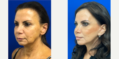 57 year old woman treated with Lip Lift - 57 year old woman treated with Lip Lift as well as Facelift, Neck Lift, Blepharoplasty and CO2 Laser, shown 5 months post op.