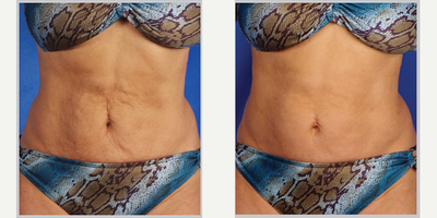 45-54 year old woman treated with Skintyte - Before/After 1 month post 1 treatment