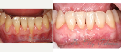 25-34 year old woman treated with Alloderm Graft - Female patient with severe recession and sensitivity on lower teeth.&nbsp; History of orthodontic treatment.&nbsp; Alloderm tissue grafting technique was used to cover the exposed roots.
