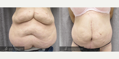 35-44 year old woman treated with Panniculectomy - Panniculectomy  35 Year Old Female