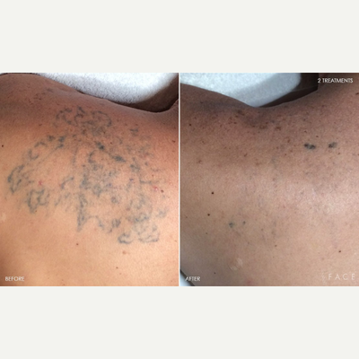35-44 year old man treated with Enlighten - Client had tried multiple laser treatments with other devices and couldn't get rid of remaining ink. Just 2 Enlighten laser treatments later it's 95% gone!