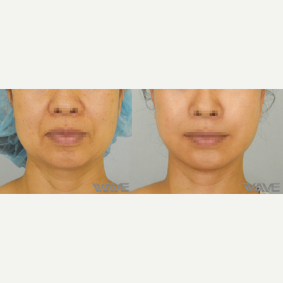 45-54 year old woman treated with Facelift - 54 yo female s/p face and neck lift