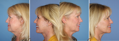 Neck lift  - 60 year young who had lower face and neck lift as in-office procedure with local anesthesia and twilight sedation.