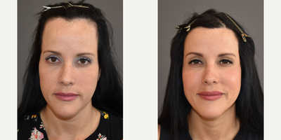 35-44 year old woman treated with Forehead Reduction - This patient felt her forehead was too high and wanted to lower her hairline. She underwent a one-stage forehead reduction/hairline lowering procedure. Here she is before and six months after the procedure.