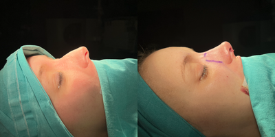 25-34 year old woman treated with Rhinoplasty - open approach subperichondrial, subperiostal rhinoplasty