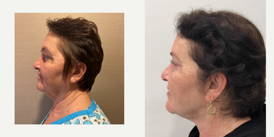 65-74 year old woman treated with Facelift, Neck Lift - deep plane lower face-necklift