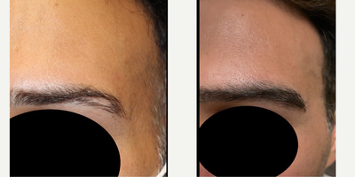 35-44 year old man treated with Eyebrow Transplant - 35 year old male 1 year post eyebrow transplant to cover a scar in the eyebrow