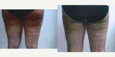 35-44 year old woman treated with Skin Rejuvenation Body Fx & Body Plus - Female addressing cellulite. Completed 5 sessions of Body Fx, fat reduction, and Body Plus, skin tightening.