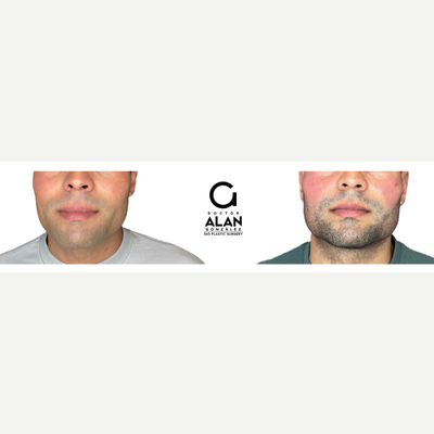 25-34 year old man treated with Ultherapy, Dermal Fillers, Radiesse - This is a non invasive treatment with microfocused ultrasound technology and visualization. Helps achieve a fresher, more youthful look from the eyebrows to the cleavage. Improves skin appearance. Generates skin retraction. Optimize collagen production. Improves tone and texture. Oxygenates and provides hydration to the treated areas.