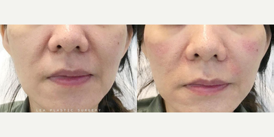 Woman treated with Dermal Fillers - Woman treated with Dermal Fillers