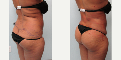 Gruber Booty  - Liposculpture Of The Buttocks - Buttocks Are Rounded And Lifted By Lipo Alone! No Injections, No Fat Grafts, No Implants. Awake, Interactive Lipo Is Safer Than Bbl With Less Recovery, No Messy Fat Leakage, No Shrinkage And Immediate Results! These Photos Are Taken Immediately After The Patients Procedure Is Finished!