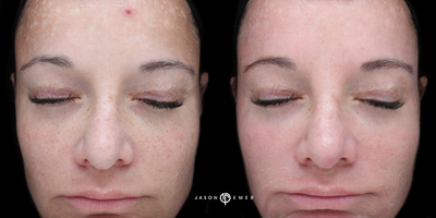 35-44 year old woman treated with Cosmelan - Woman treated with cosmelan for melasma