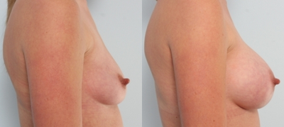 Breast Augmentation - 
	Age 28, the patient in these Before/After photos is from Austin. She went from a size B cup to a D cup after breast augmentation, with a 421cc Natrelle Gel implant on the right and a 339cc implant on the left, correcting asymmetry and proportionately filling out her chest.
