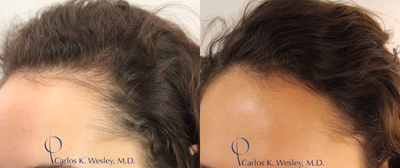 18-24 year old woman treated with PRP for Hair Loss - Patient treated with PRP for Hair loss