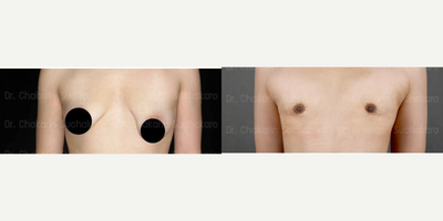 25-34 year old woman treated with FTM Chest Masculinization Surgery - 25-34 year old woman treated with FTM Chest Masculinization Surgery, shown 2 months post op. Patient had tubular breast condition.