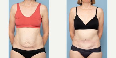 35-44 year old woman treated with Diastasis Recti Repair, Tummy Tuck - 44 year old3 childrenRepair of diastasis + Umbilical Hernia8 months post op