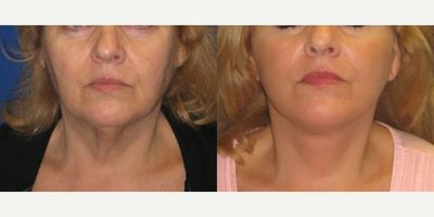 55-64 year old woman treated with Fat Transfer and a Face and Neck Lift - My patient was not happy with her tired appearance and heavy neck. She has hollowed cheeks and under eyes and heavy jowls with hanging neck skin. She underwent a face and neck lift with a facial fat transfer to her cheeks, under eyes and nasolabial and marionette area with wonderful improvement in her facial volume an neck profile.