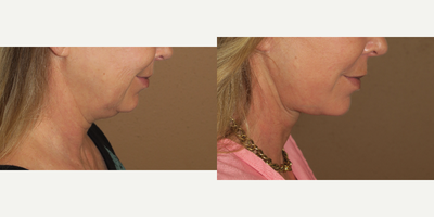 45-54 year old woman treated with Neck Lift - neck lift