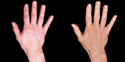 45-54 year old female treated with Hand Rejuvenation - Hand rejuvenation with dermal fillers