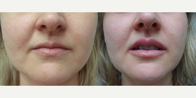 35-44 year old woman treated with Restylane - This patient had her lips enhanced with Restylane