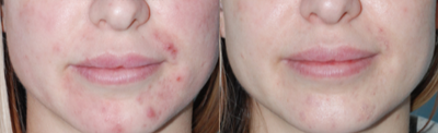 25-34 year old woman treated with Affirm Laser - female patient treated for acne with the Affirm laser with excellent quick results.