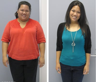 Before & After - 
	12 months post-op

