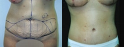 Panniculectomy - Panniculectomy