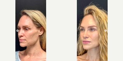 Woman treated with Brow Lift - My beautiful, beautiful patient. She was gorgeous before and all we did was my DEFINE LIFT. A Deeplane Extended Facelift Including Necklift, the Elevation of the brows, and a touch of fat transfer. You can see she looks like herself just rejuvenated. My goal with facelift rejuvenation is always to try to make the patient a little more prettier or handsome. It's never meant to change the way they look. I think we nailed it! No one can tell what she had done other than she looks gorgeous!