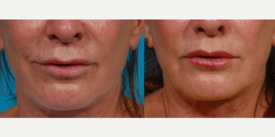 55-64 year old woman treated with Lip Lift - 60 year old woman interested in dermal filler in her lips. The doctor assessed her upper lip and determined with age the skin can stretch and make the upper lip almost disappear. He recommended a lip lift which can be performed in an office setting under a local anesthetic.