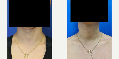 25-34 year old transgender woman treated with Transgender Facial Feminization Surgery - This is a transgender patient (male to female) in her early 30s who came to Dr. Katzen for a tracheal shave (also known as shaving of the Adams apple). Many transgender patients come in for this procedure when wanting a more feminine look. Dr. Katzen makes a tiny horizontal incision in the fold of the neck to then reduce the trachea. This patient was very happy with her results and smooth neck. She paired this procedure with breast augmentation with silicone implants. Those photos can be found in the breast augmentation section of the website.
