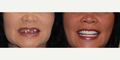 All-on-4 Dental Implants - All-on-4 Dental Implants