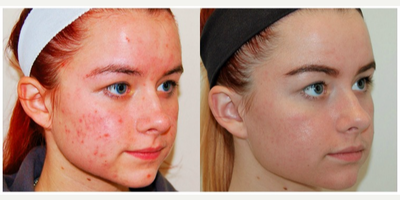 18-24 year old woman treated with Isolaz - This patient was able to clear up her pervasive acne break-outs with a customized regimen of Isolaz and home-care products.