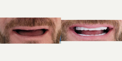 35-44 year old man treated with Dental Implants, Dental Bridge, Dental Crown, Full Mouth Reconstruction, Smile Makeover - Full Mouth Reconstruction with Dental Implants, Full Smile Makeover,x24 Zirconium Crowns