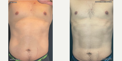 25-34 year old man treated with truSculpt flex, truSculpt iD - 12 weeks from first session in September 2022. Photos taken after TruBody treatment. Includes one truSculpt ID and four truSculpt flex+ treatments.