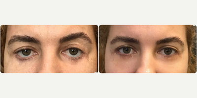 35-44 year old woman treated with Eyelid Retraction Repair, Eyelid Surgery - Lower eyelid retraction repair following lower eyelid transcutaneous blepharoplasty.