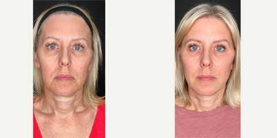 45-54 year old woman treated with Opus Plasma - This client wanted to address her fine lines and wrinkles along with skin laxity. Her results are after only one Opus Plasma treatment followed by applying topical Exosomes.
